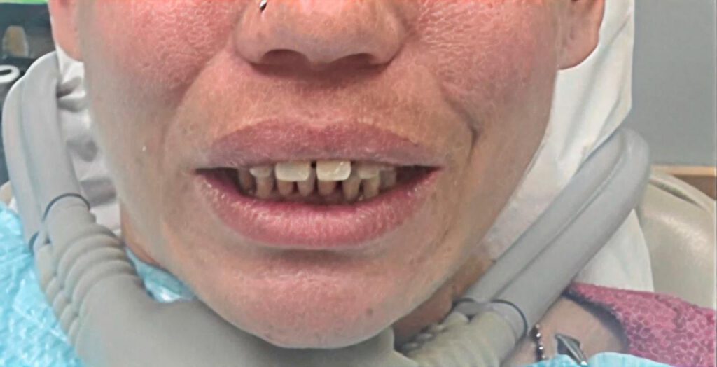 Patient smile before denture treatment at First Choice Denture Clinic